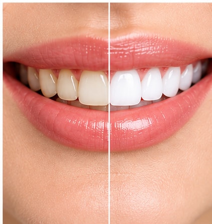 Teeth Whitening