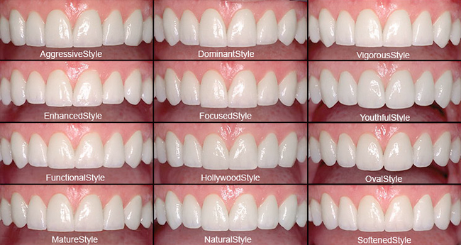 Dental Veneers; Dental Laminates