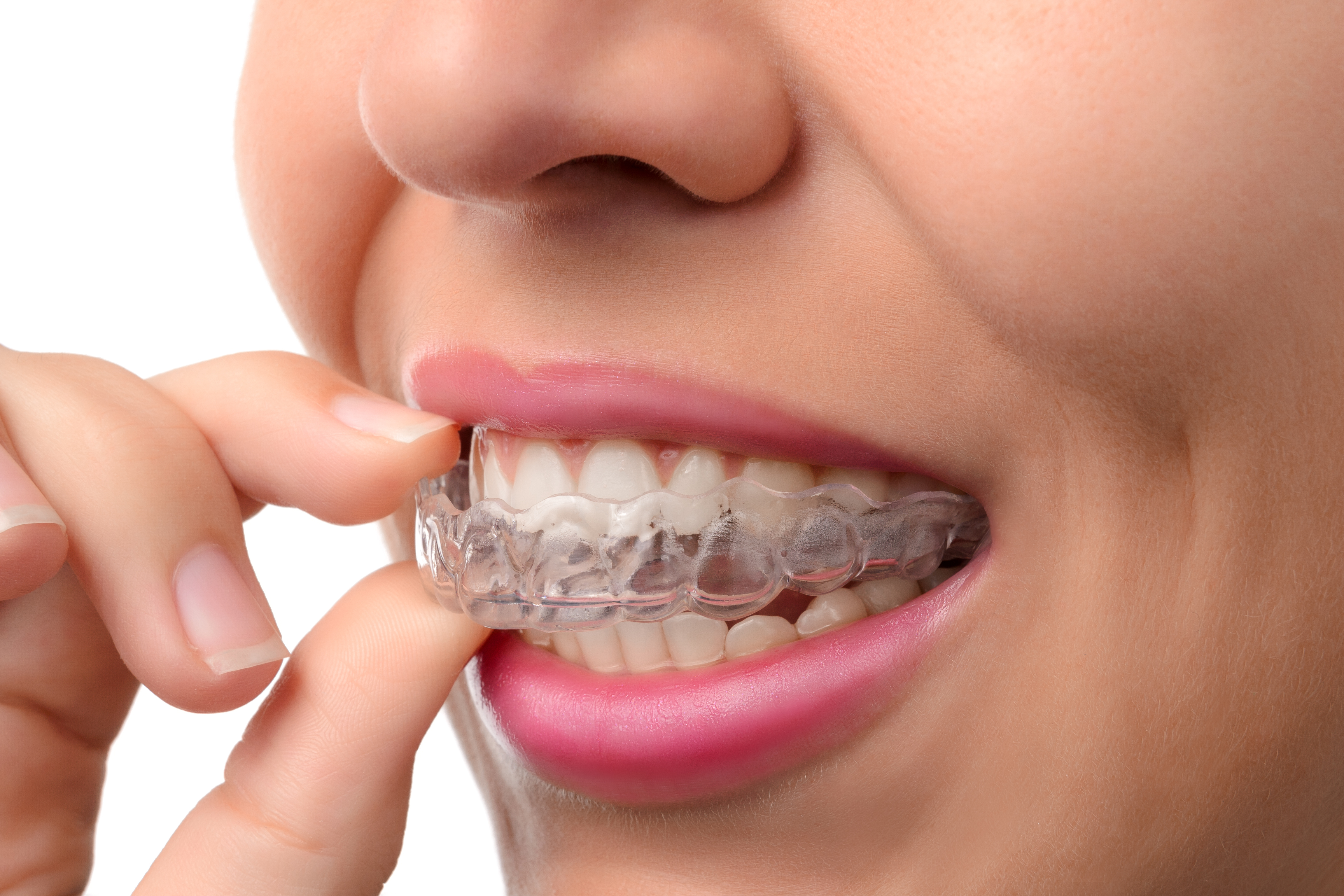 Invisalign braces