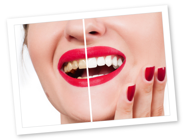 Benefits of the Zoom!® Teeth Whitening System